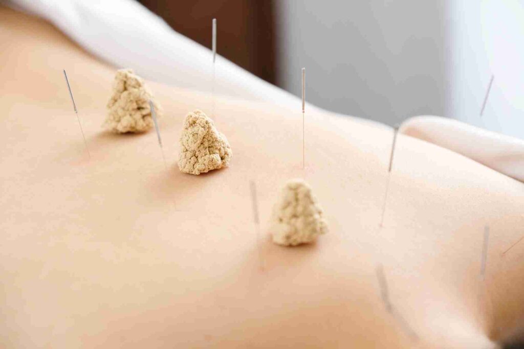 Les bienfaits de l'acupuncture