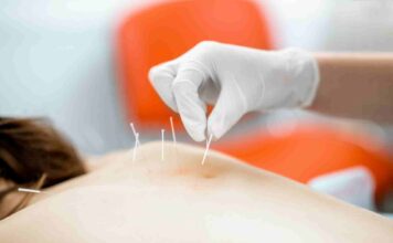 Les bienfaits de l’acupuncture pour la beauté