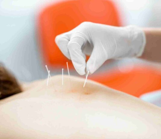 Les bienfaits de l’acupuncture pour la beauté