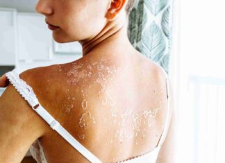 Comment traiter naturellement la peau sèche ?