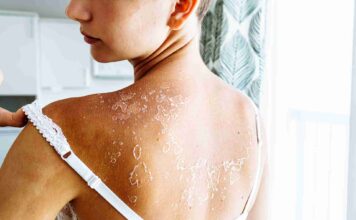 Comment traiter naturellement la peau sèche ?