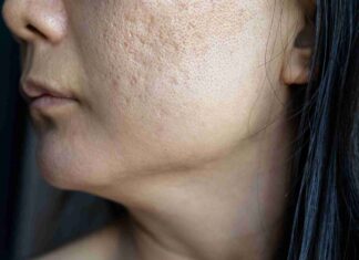 Comment atténuer naturellement un trou dans la peau du visage ?